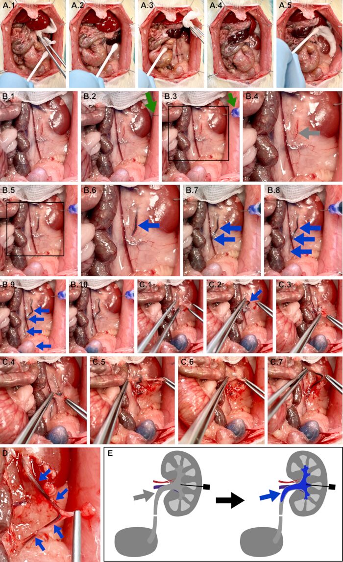 Surgical procedure sequence with diagrams of ureter relocation, highlighting kidney anatomy process.
