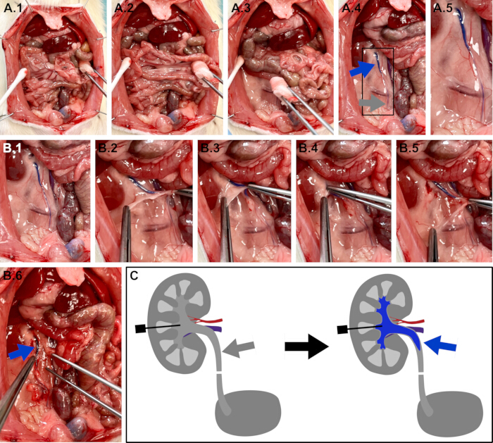 Kidney transplant surgical steps and schematic diagram, showing anatomical connections and procedure.