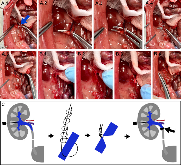 Surgical procedure sequence diagram, renal artery intervention, vascular repair demonstration.