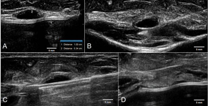 figure-protocol-1 Ultrasound imaging, cross-sectional views, labeled distances, anatomical structure analysis, medical diagnostics.