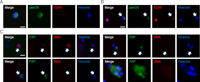 Fluorescence microscopy of cell markers with panCK, CD45, FAP, SMA, and Hoechst staining.