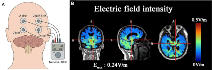 Transcranial electrical stimulation setup and MRI intensity diagram showing electric field distribution.