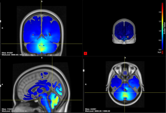 Brain MRI scan, color-coded regions, coronal and axial slices, image analysis for brain activity.