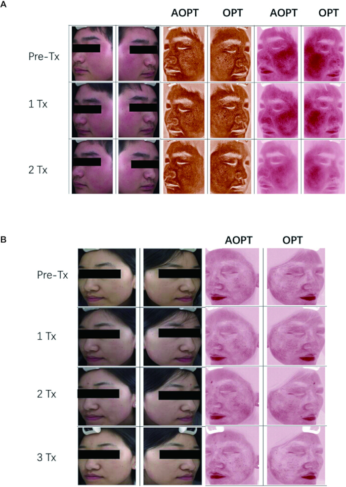 figure-results-4 Facial treatment progress diagram; AOPT vs. OPT; pre-Tx, Tx1, Tx2; enhancement analysis.