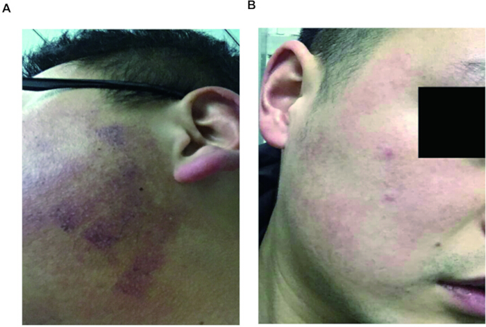 figure-results-5 Facial bruising recovery progression, pre- and post-treatment comparison, medical observation.