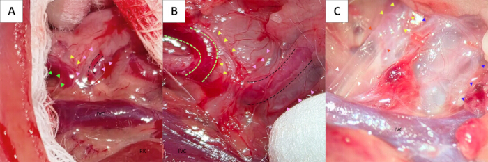 Surgical procedure diagram showing anatomical dissection stages with emphasis on vascular structures.