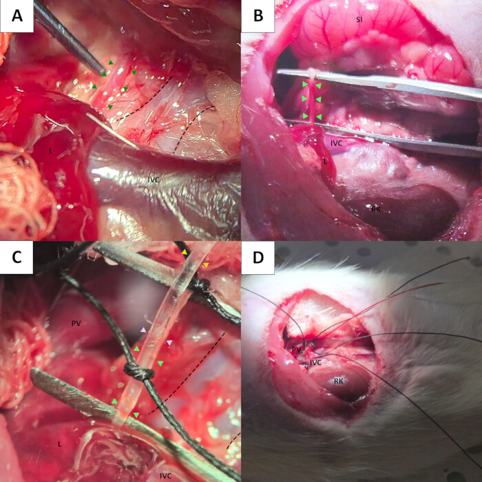 Surgical procedure diagram showing IVC catheterization setup for intravenous access and monitoring.