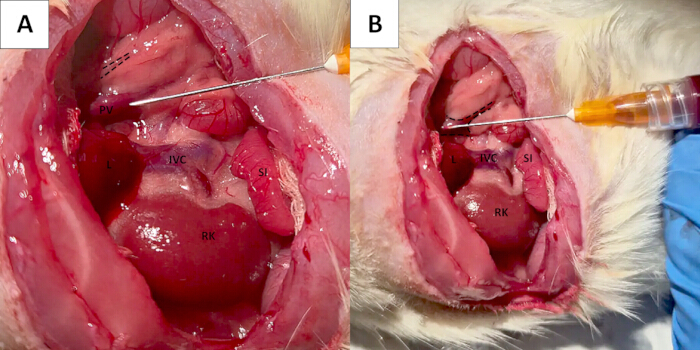 Surgical procedure showing liver injection in two steps; needle, liver, IVC, SI, RK explained.