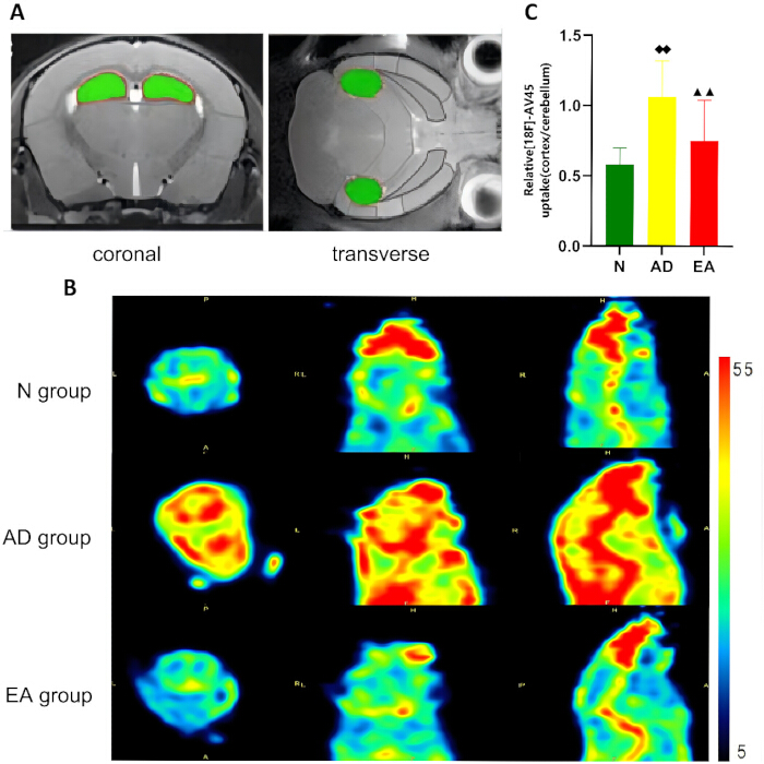Brain imaging analysis; coronal/transverse MRI, heatmaps, bar graph; data for N, AD, EA groups.