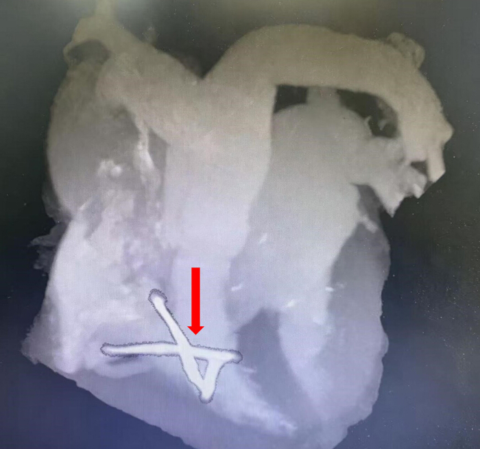 figure-results-1 3D CT scan image showing foreign object in human heart, surgical planning, medical imaging analysis.