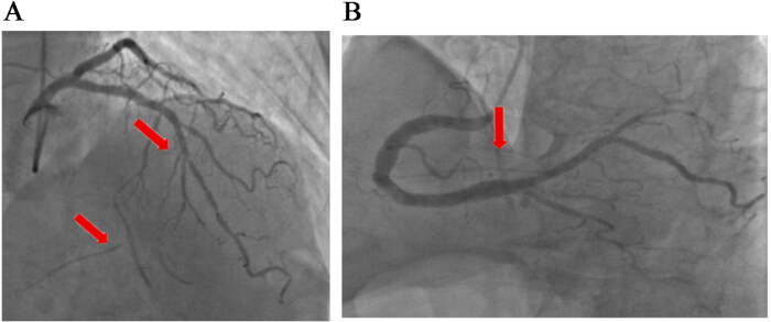 figure-results-2 Coronary angiography; arrows indicating artery blockages; medical imaging; cardiovascular diagnosis.