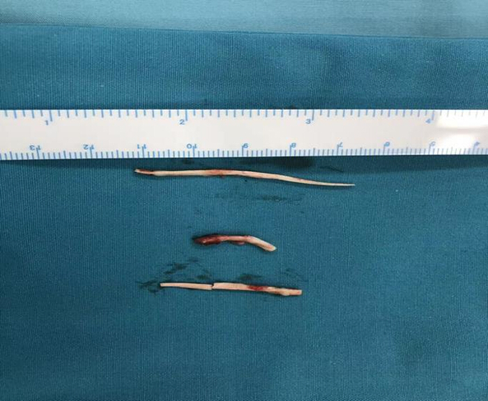 figure-results-4 Fish bone specimen measurement on surgical drape with ruler, anatomical size comparison study.