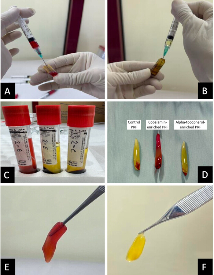 figure-protocol-1 Platelet-rich fibrin separation, PRF preparation; steps involve blood collection, labeling, analysis.