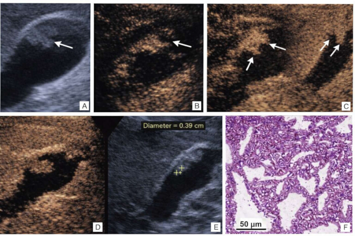 figure-results-2 Ultrasound images, arrows highlight structures, diameter measurement, histology slide close-up.