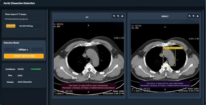 figure-protocol-2 Aortic dissection detection via CT scan, analysis of HRNet-c model, results display.