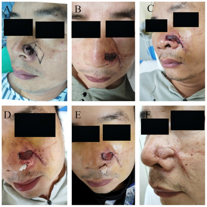 Surgical reconstruction process on nasal area; multiple stages; medical case study images.