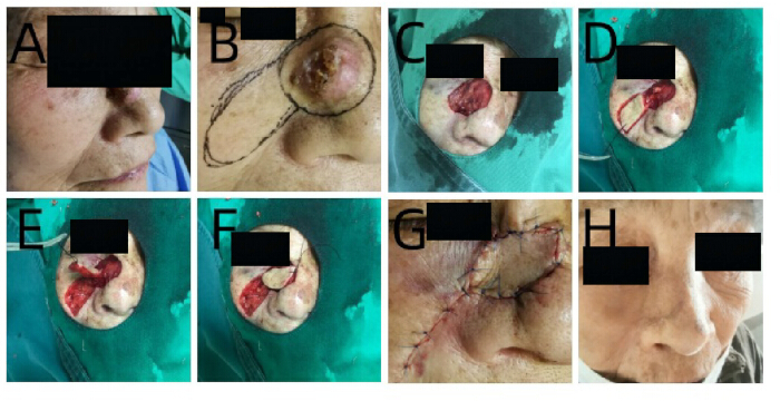 Skin graft procedure steps, medical diagram showing nasal reconstruction after tumor removal.