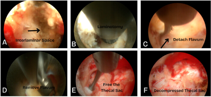 Endoscopic spine surgery sequence: interlaminar space, laminotomy, flavum detachment, decompression.