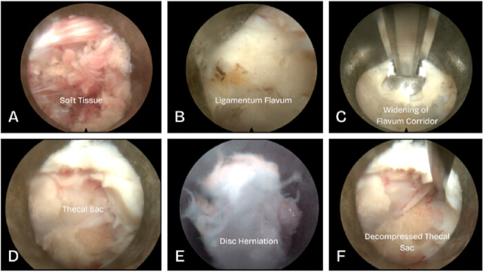 Endoscopic spinal surgery process: soft tissue, ligamentum flavum, disc herniation, decompression steps.