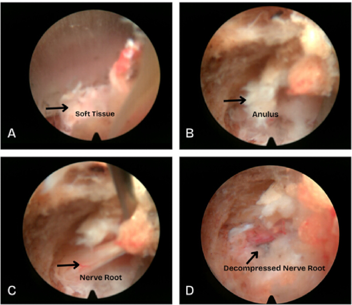 Endoscopic spine surgery process, showing soft tissue removal and nerve root decompression.
