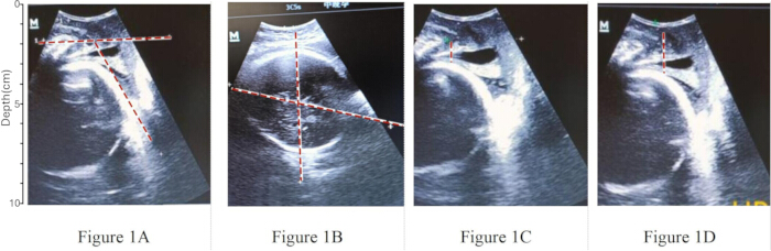 Ultrasound cross-sectional images of organ depth, showing measurement markers and anatomical analysis.