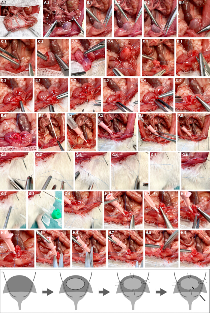 Surgical procedure diagram for bladder augmentation, showing steps and instruments used.