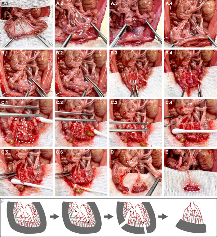 Surgical technique progression diagram showing intestinal anastomosis procedure and suture application.
