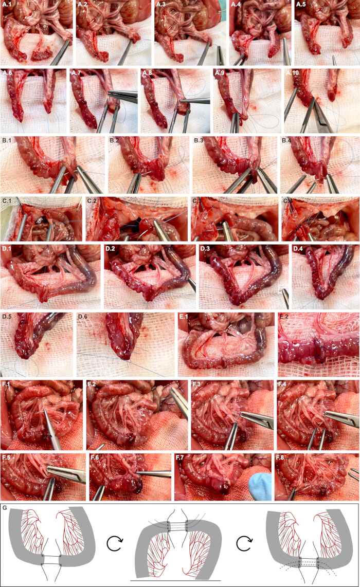 Surgical anastomosis process; intestinal repair; step-by-step procedure; medical diagram.