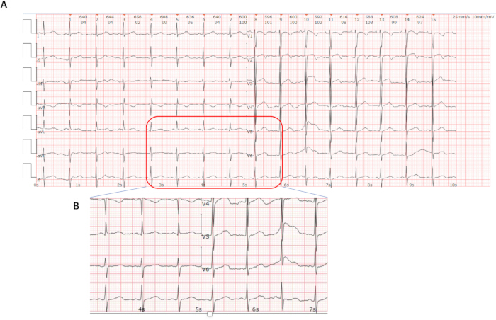 figure-introduction-1 ECG waveform analysis, electrocardiogram results, heart rhythm data, diagnostic chart.