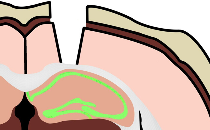 Cross-sectional diagram of sinus anatomy, highlighting sinus cavity with green pathway.