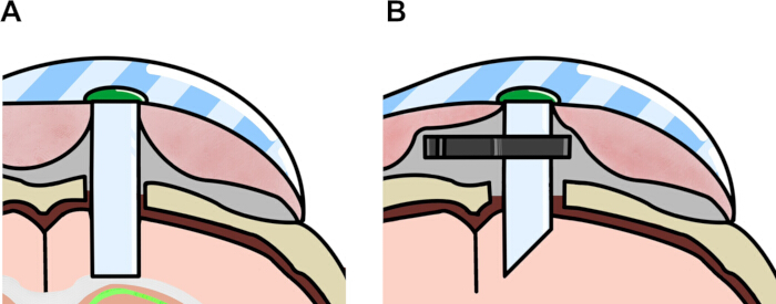 Neurosurgical technique diagram; A, B incisions with implanted electrode details for study.