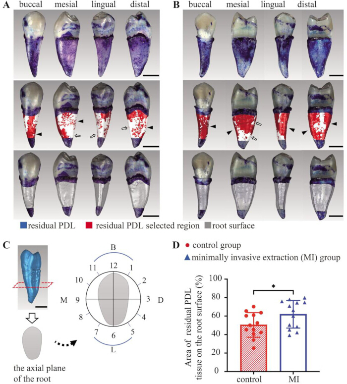 figure-results-3 Tooth analysis diagram, highlighting residual PDL, with comparative graph for PDL extraction study.