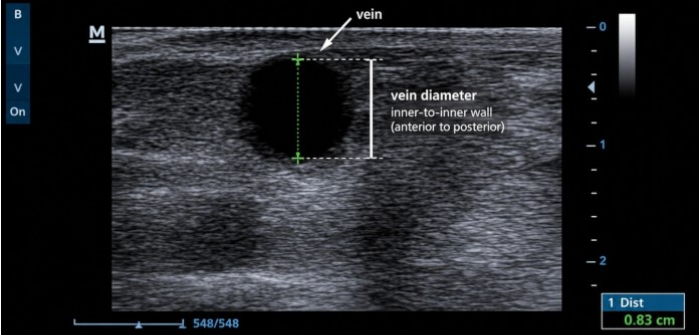 Ultrasound diagram, vein diameter measurement, medical imaging, inner wall dimensions.