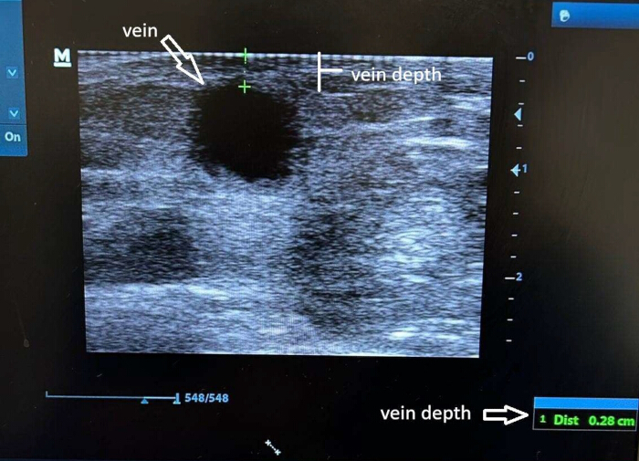 Ultrasound imaging, vein depth measurement, diagnostic ultrasound, medical imaging, vein analysis.