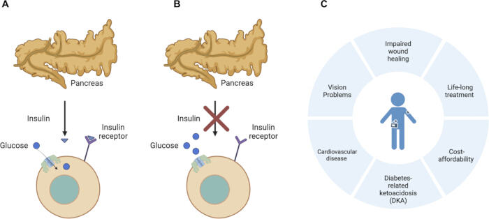 Pancreas role in glucose uptake via insulin, receptor interaction; diabetes impact diagram.