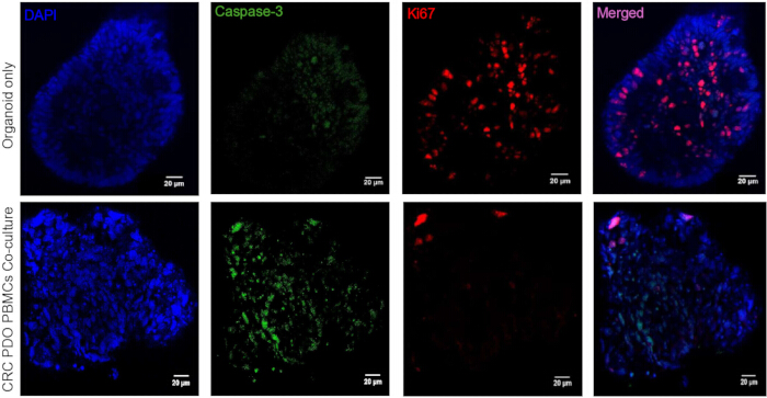 Fluorescence microscopy of organoids; DAPI, Caspase-3, Ki67 staining; CRC PDO PBMCs co-culture.