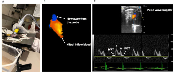 Ultrasound imaging of mitral inflow blood; includes Doppler analysis, flow direction, heart study.