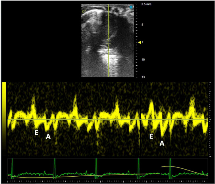 Cardiac ultrasound diagram displaying Doppler echocardiography velocity waves and heart motion analysis.