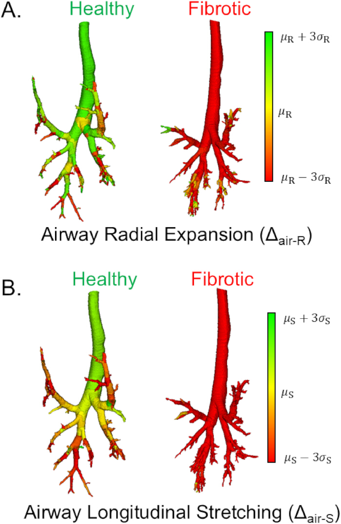 Airway expansion and stretching diagram; healthy vs. fibrotic; Δ_air-R, Δ_air-S; radial, longitudinal.