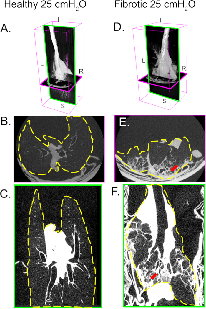 CT scan comparison of healthy vs fibrotic lungs at 25 cmH2O, highlighting structural differences.