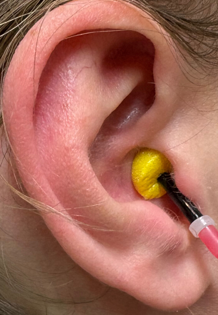 Earwax removal method, close-up using irrigation tool, hygiene process, medical technique.