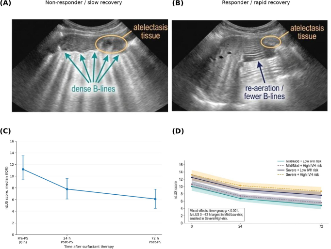 Ultrasound showing atelectasis, B-lines density. Graphs indicate recovery post-surfactant therapy.