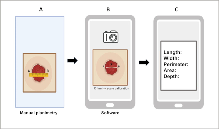 Wound measurement: Planimetry method using software and camera for accurate area and depth analysis.