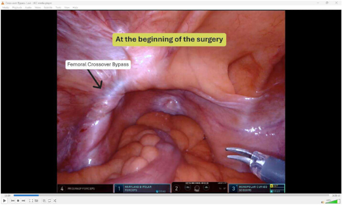 figure-results-2 Surgical diagram of femoral crossover bypass, showing initial incision and instrument positioning.