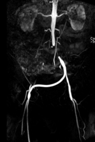 figure-results-1 Medical imaging angiography; diagram displaying abdominal aorta artery and branches.