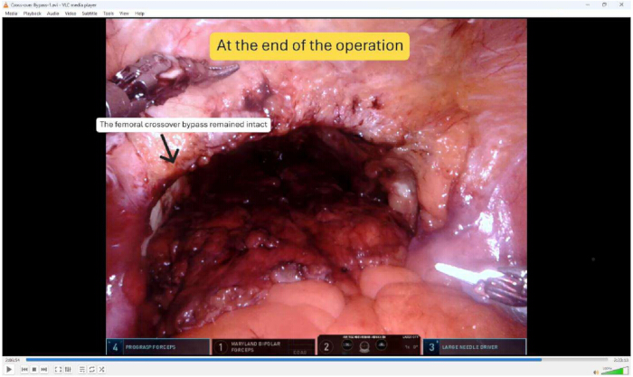 figure-results-3 Surgical procedure image showing femoral crossover bypass intact, end of operation status.