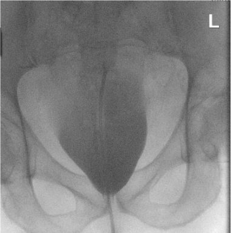 figure-results-4 Pelvic X-ray showing static equilibrium; radiology result for structural analysis in orthopedic study.