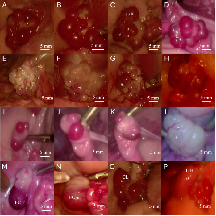 Colonoscopy findings; multiple polyps at 5mm scale, detailed views, medical diagnostic procedure.