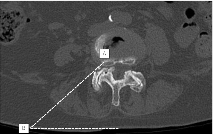 figure-results-1 CT scan diagram, abdominal anatomy, labeled A and B, medical imaging, diagnostic analysis.