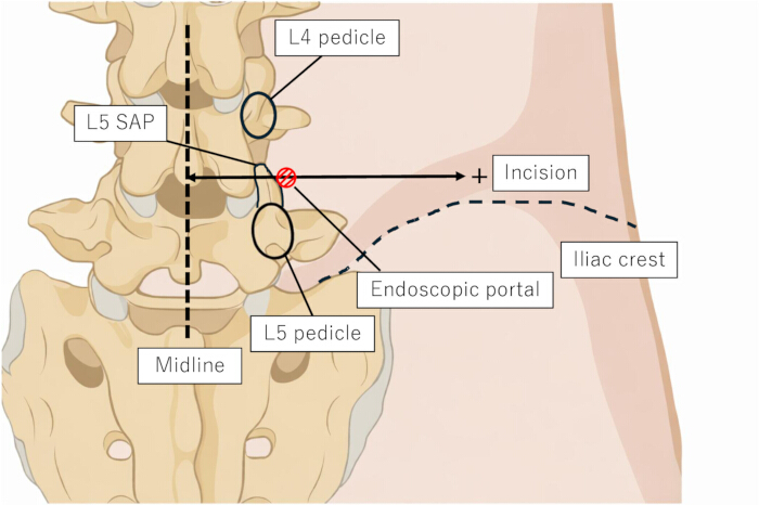 figure-results-2 L4-L5 spinal anatomy diagram; endoscopic setup for surgical incision, pedicle, iliac crest landmarks.